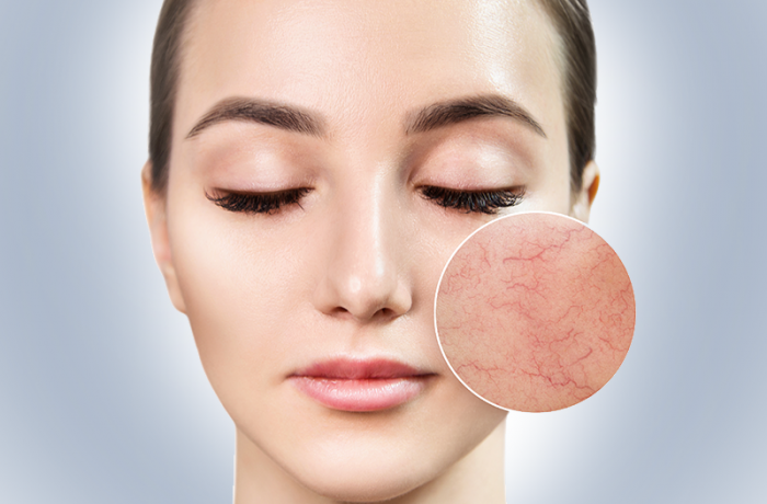 Laser Vasculaire et Couperose