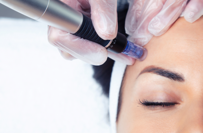 Laser Infra Rouge avec Microneedling