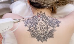 Détatouage – Tâches Pigmentaires