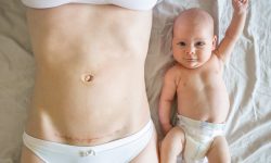 Cicatrisation de la césarienne